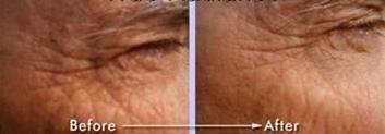 Best Lineless Eye Cream Reduces Crows Feet, Dark Circles and Puffinesss. Anti-wrinkle and More. 10% Reguage, 10% Syncoll, 8% Pepha-tight, Dmae. Paraben Free. 1/2 Oz Eye Cream