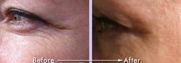 Best Lineless Eye Cream Reduces Crows Feet, Dark Circles and Puffinesss. Anti-wrinkle and More. 10% Reguage, 10% Syncoll, 8% Pepha-tight, Dmae. Paraben Free. 1/2 Oz Eye Cream