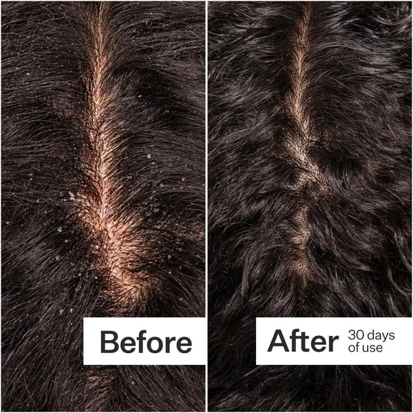 ACT+ ACRE Microbiome Cooling Scalp Serum - Instant Relief for Dry Itchy Scalp & Loose Flakes - Peppermint Oil & Amino Acid for Scalp Balance - Natural, Vegan, Paraben-Free Formula - 2.2 fl oz