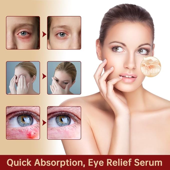 Chalazion Eye Treatment For Blepharitis, 2 PCS Moisturize Eyelids Serum and Chalazion Remover, Gentle Under Eye Relief Serum For Dark Circles, Eye Bags, Puffiness.