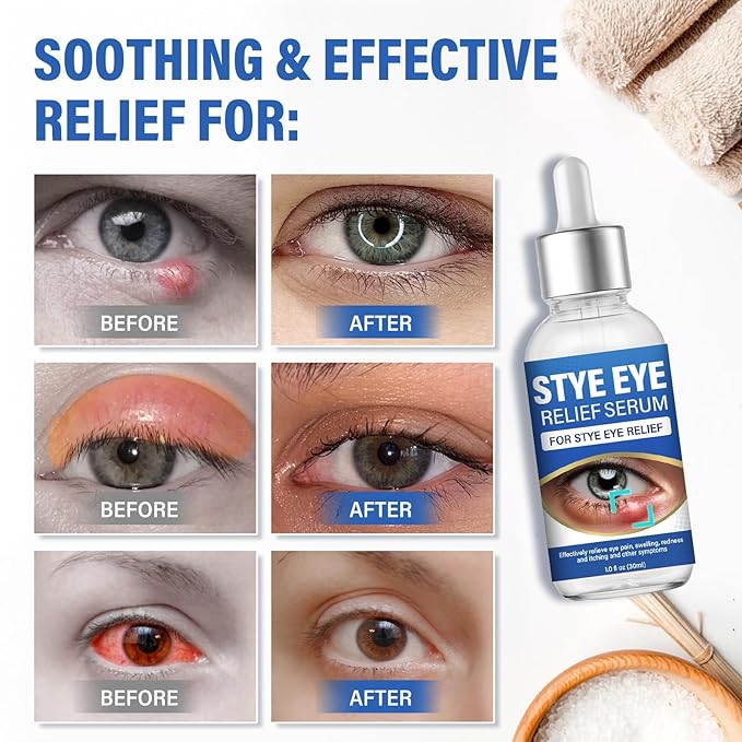 St_ye Eye Treatment, Natural Eye Serum for Chalazion and Blepharitis Treatment, Leading to Soothed and Restored E-ye Areas, 1 Fl.oz