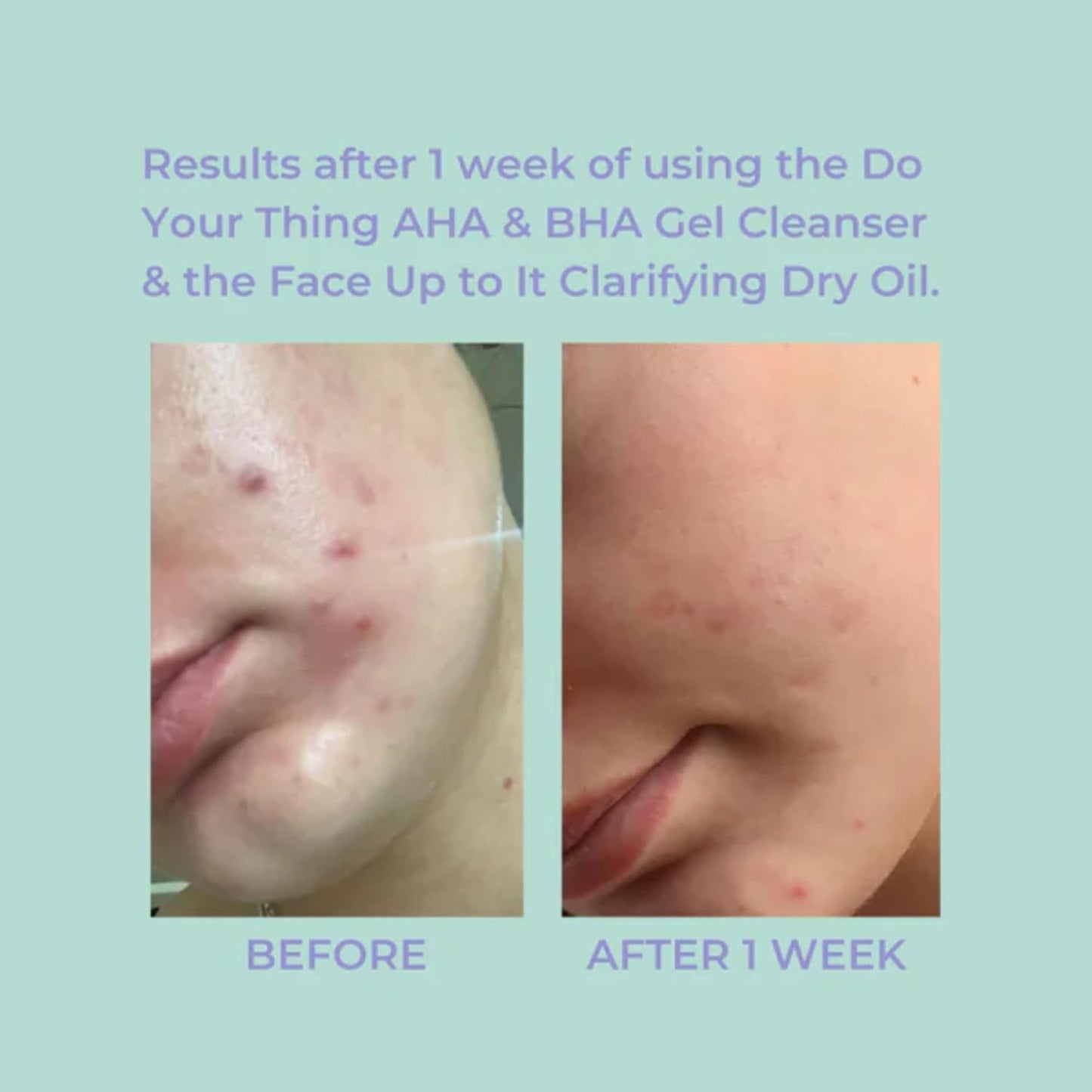 Evre Do Your Thing AHA & BHA Teen Gel Acne Face Wash, 3.4 FL Oz, Oil Control Face Cleanser with Niacinamide & Salicylic Acid, Blemish Control