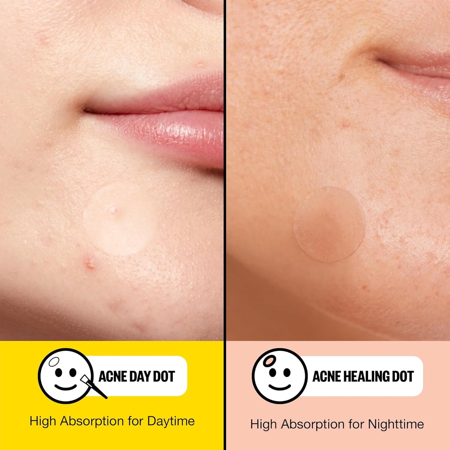 PEACE OUT Acne Day & Night Duo, Sheer Hydrocolloid Pimple Patches For Day Plus Overnight Acne Dots, Helps Clear Blemishes Quickly with Salicylic Acid, Retinol and Aloe Vera, 20 dots