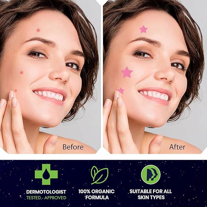 Star Pimple Patches for Face β Hydrocolloid Acne Patches for Quick Zit Relief And Blemishes, Invisible Spot Stickers That Stay All Night, Gentle for All Skin Types, Oil-Free (80 Count)