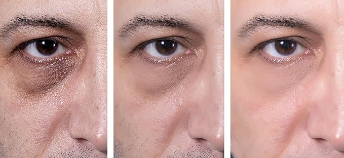 Eye Gel, for Dark Circles, Puffiness, Wrinkles, Skin Firming and Bags - Effective Anti-Aging Eye Gel for Under and Around Eyes including Crows Feet with Hyaluronic Acid and Aloe Vera- 1.7 fl. oz.