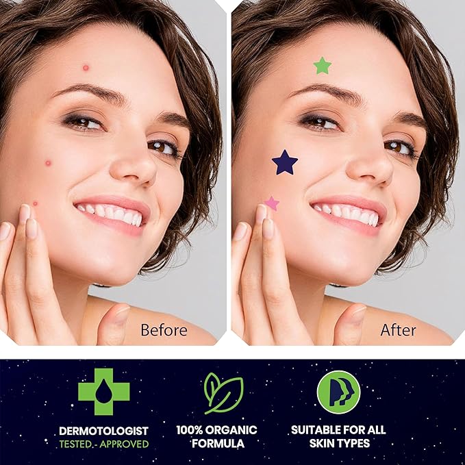 Star Pimple Patches for Face β Hydrocolloid Acne Patches for Quick Zit Relief and Blemishes, Invisible Spot Stickers That Stay All Night, Gentle for All Skin Types, Oil-Free (240 Count)