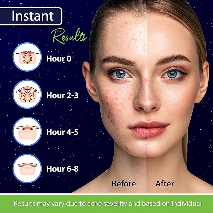 Star Pimple Patches for Face β Hydrocolloid Acne Patches for Quick Zit Relief And Blemishes, Invisible Spot Stickers That Stay All Night, Gentle for All Skin Types, Oil-Free (80 Count)
