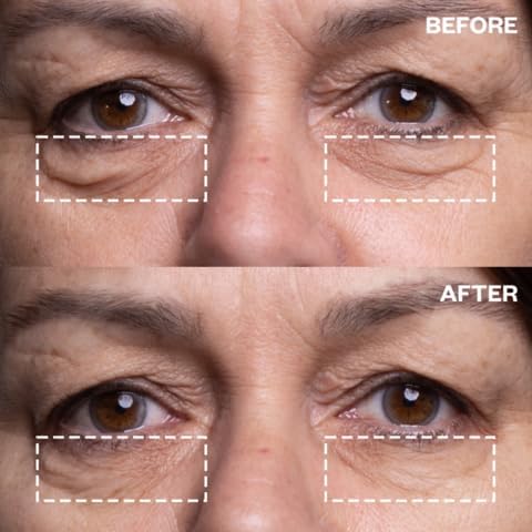 Wrinkles Schminkles Eye & Mouth Lift Set | Mouth & Lip Wrinkle Patch 2-Pack & Eye Wrinkle Patches 3-Pairs | Reusable Medical Grade Silicone Patches