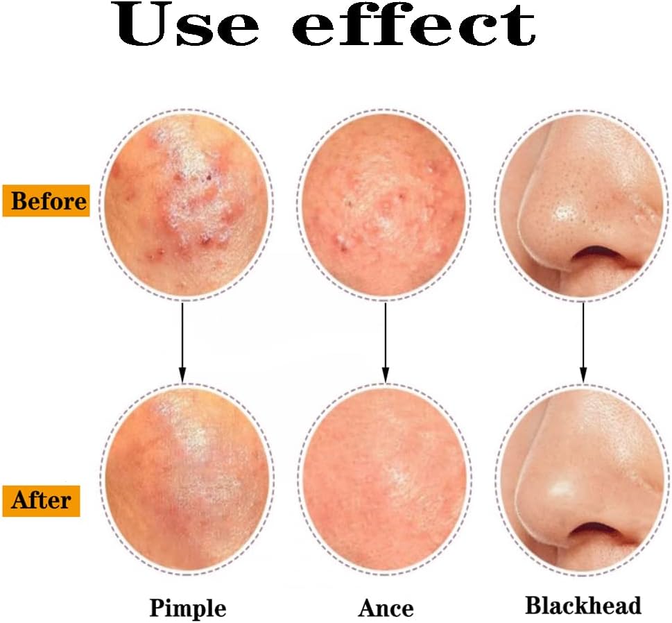 Professional Blackhead Remover Pimple Popper Tool,Comedones Extractor Acne Removal Tweezers for Blemishs，Whitehead Popping,Zit Removing for Nose Face,Stainless Steel Makeup Tool