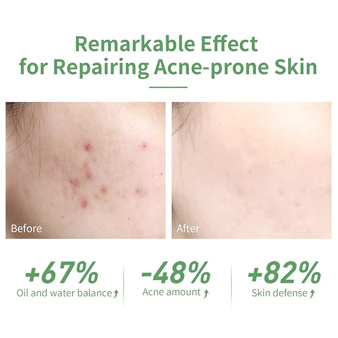 LANBENA 10% Salicylic Acid Serum, Acne Repair, Dead Skin Peels, Relieve Redness, Soothing Calming for Acne Prone Sensitive Facial Skin Care