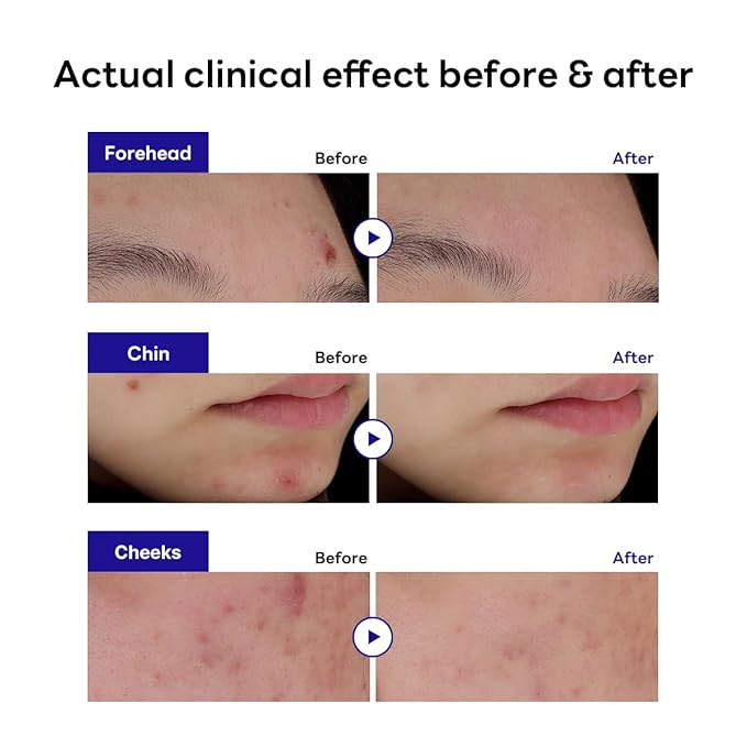 Mediheal Derma Clear Madecassoside Blemish Spot Patch (132 Counts) - Acne Spot Protection, Spot Fast Healing with Madecassoside & Niacinamide