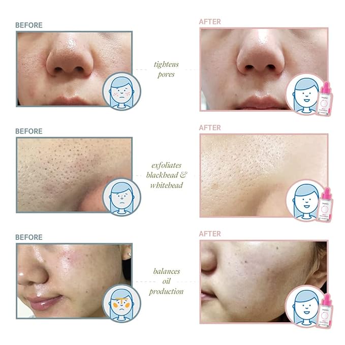 beplain 0.2% Salicylic Acid Serum | BHA Gentle Exfoliating Serum | Pore Refining, Oil & AcneControl | 1.01fl.oz | Korean skin care