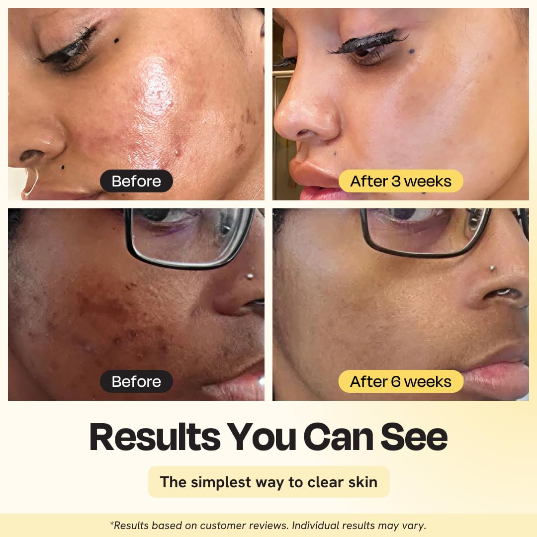 Gleamin Vitamin C Clay Mask for Dark Spots, Turmeric Clay Face Mask Skin Care, Deeply Cleanses & Refines Pores, Brightens Uneven Tone and Helps Improve Post-Blemish Scarring & Texture - 5 Oz