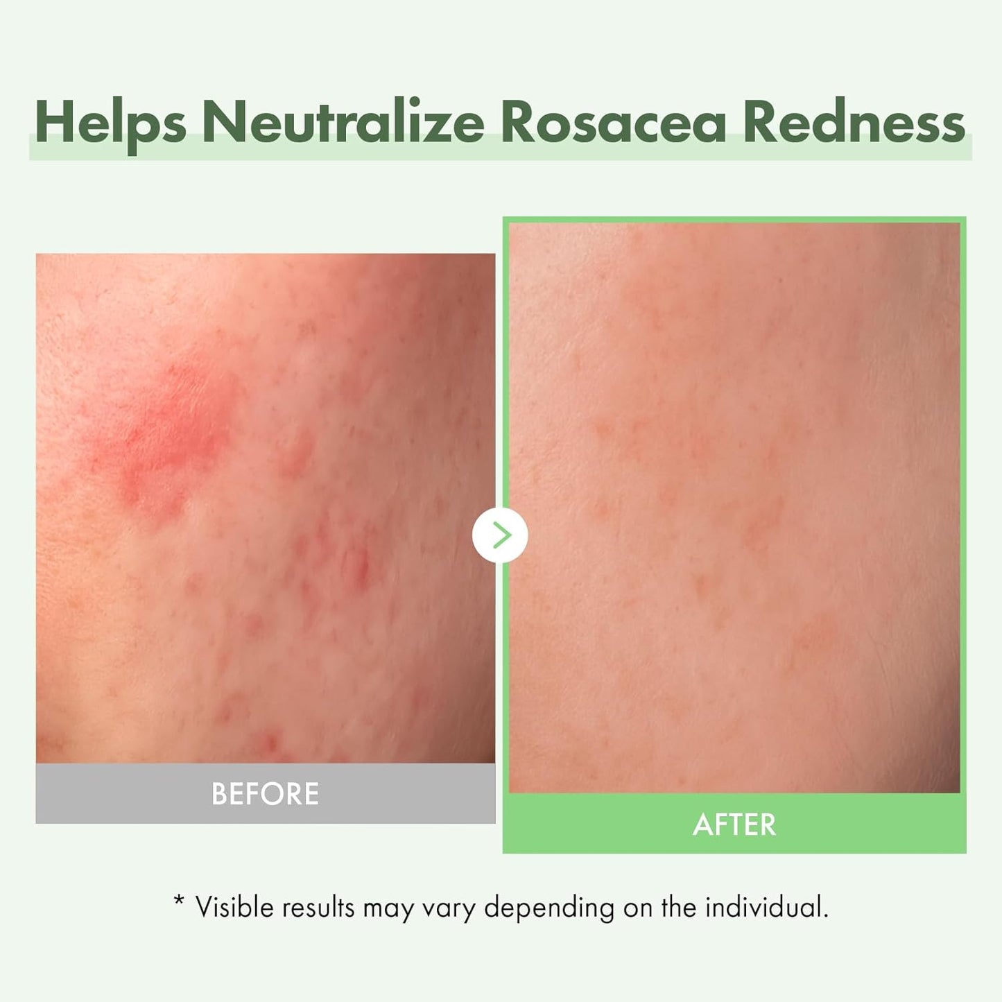 TOSOWOONG Azelaic Acid 10% Face Serum, Rosacea care, Redness Soothing and Blemish, Centella Asiatica for Acne-prone, Niacinamide, Hyaluronic Acid, Korean Skincare, Natural Color, 33 ml / 1.11 fl. oz.