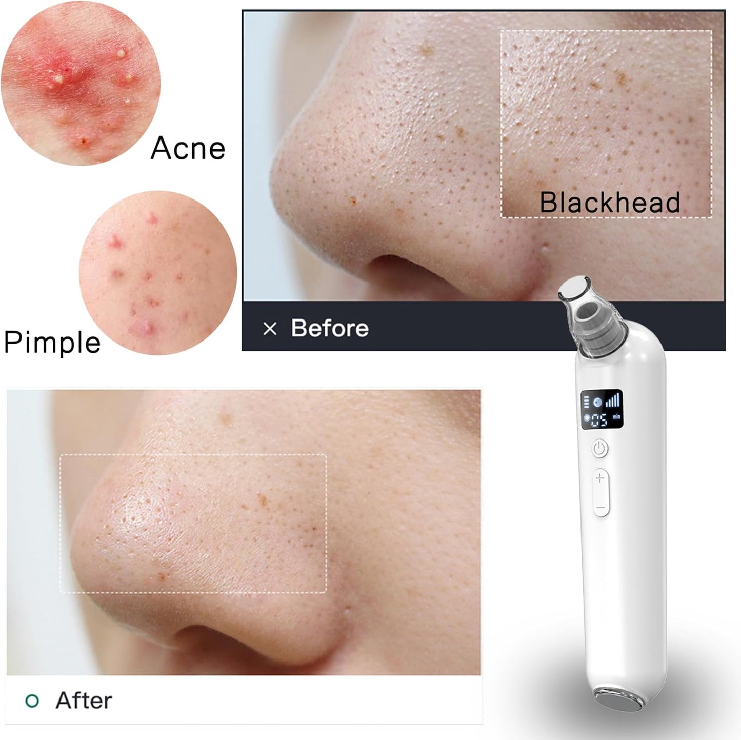 Vacuum Blackhead Remover Pore Cleaner with Heat & Red Light 5 Suction Levels Nose Pore Cleaner Rechargeable with LED Display, 6 Probes & Bonus Blemish Extractor Tools, Skincare Gift for Women