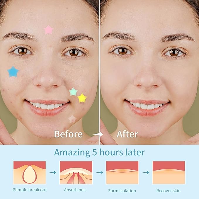 200 Counts Star PimPle Patches for Face, Hydrocolloid Acne Pimple Patch with Tea Tree Oil for Party Gift Covering Zits Blemishes