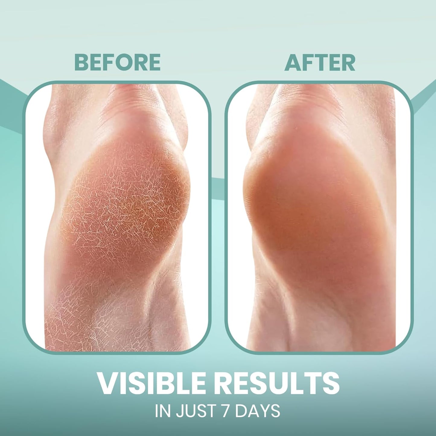 Moisturizing Heel Socks for Cracked Heels - Gel Socks for Dry Cracked Feet Repair - Silicone Socks for Women’s Foot Treatment & Overnight Hydration (Black, 2-Pair)