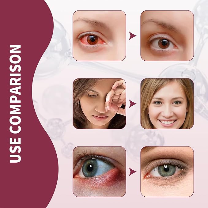 Stye Eye Treatment, Chalazion Remover, Gently Cleanses Lashes and Eyes, Restore Healthier Eye Skin