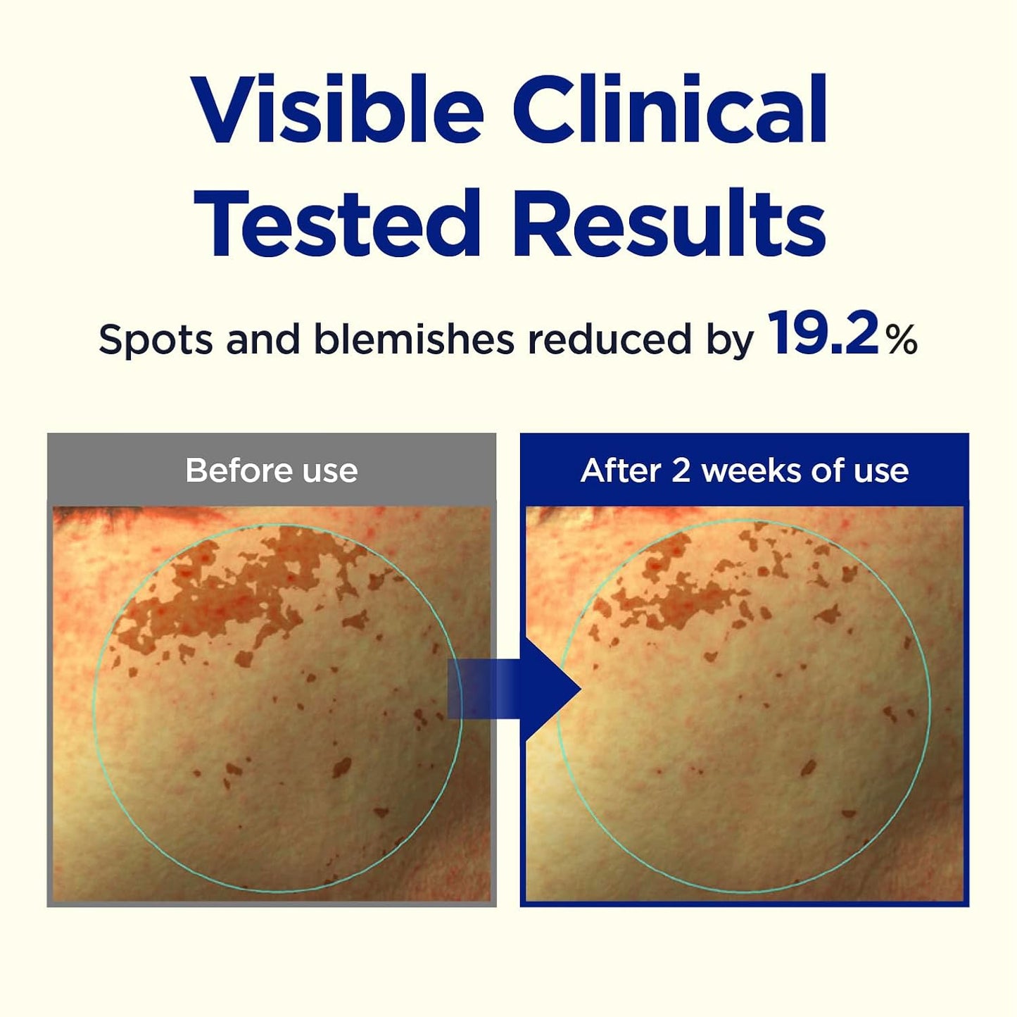 CKD Triple Blemish Under Eye Gel Patch 60 Counts - Hydrogel Spot Treatment, Gentle Formula for Blemish Improvement, Even Tone and Minimize Puffiness with 99% Pure Vitamin C and Teca.