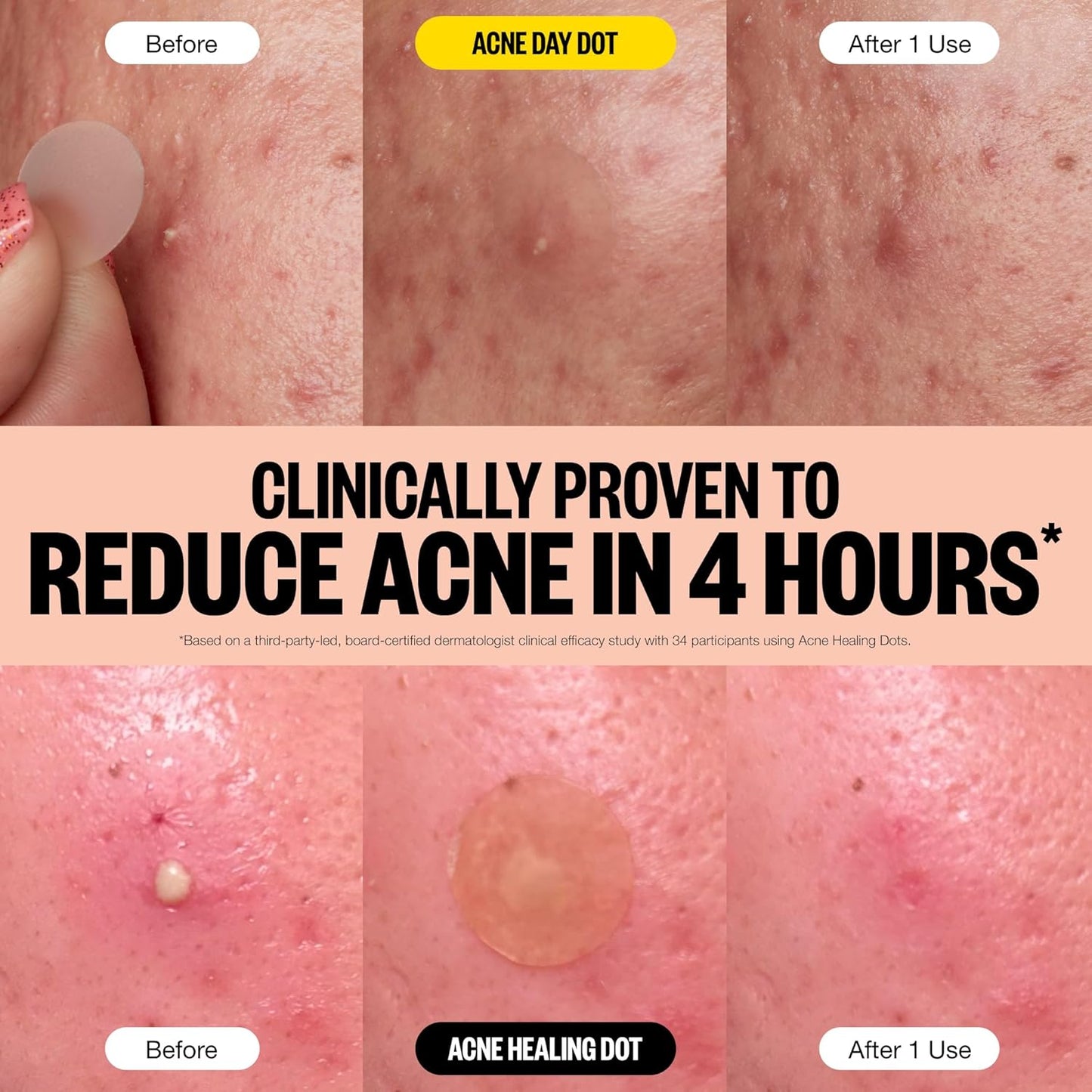 PEACE OUT Acne Day & Night Duo, Sheer Hydrocolloid Pimple Patches For Day Plus Overnight Acne Dots, Helps Clear Blemishes Quickly with Salicylic Acid, Retinol and Aloe Vera, 20 dots